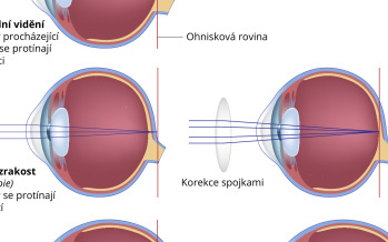 Krátkozrakost