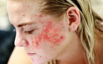 Lupus erythematodes