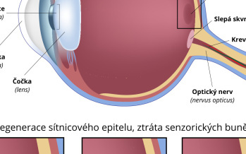 Makulární degenerace