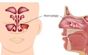 Nosní polypy