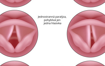 Ochrnutí hlasivek