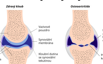Osteoartritida
