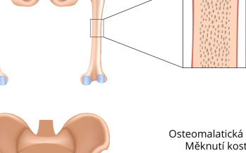 Osteomalacie