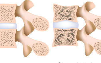 Osteoporóza bederní páteře