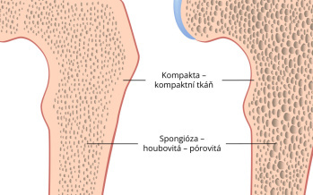 Osteoporóza