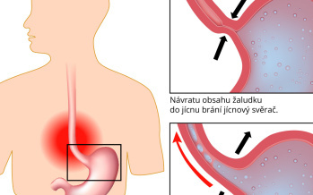 Pálení žáhy