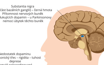 Parkinsonova nemoc