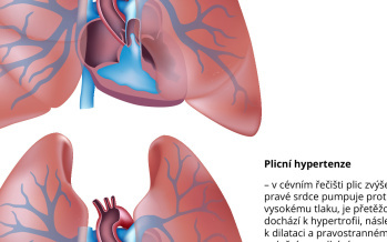 Plicní hypertenze