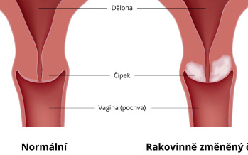 Rakovina děložního čípku