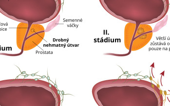 Rakovina prostaty