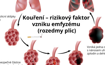 Rozedma plic