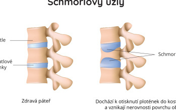 Schmorlovy uzly