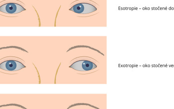 Strabismus