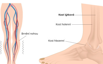 Syndrom neklidných nohou