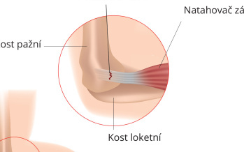 Tenisový loket