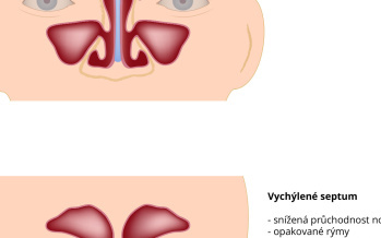 Vychýlená nosní přepážka