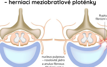 Výhřez meziobratlové ploténky