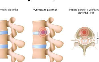 Výhřez meziobratlové ploténky