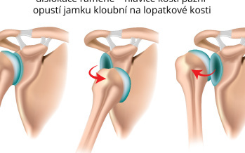 Vymknuté rameno