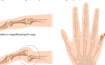 Vymknutí kloubu prstu ruky