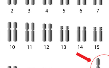 XYY syndrom
