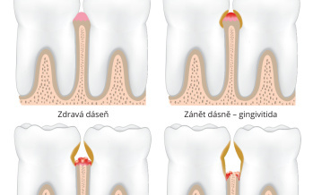 Zánět ozubice