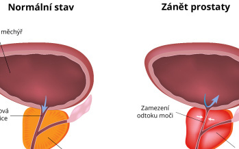 Zánět prostaty