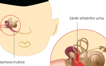 Zánět středního ucha