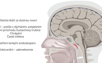 Odstranění nosních mandlí - Adenotomie