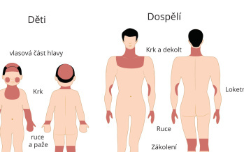 Atopický ekzém