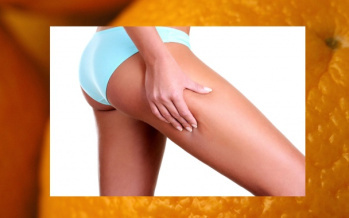 Celulitida