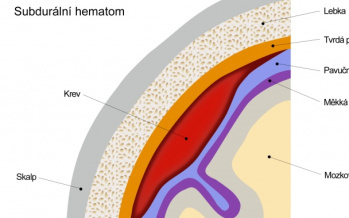 Hematom