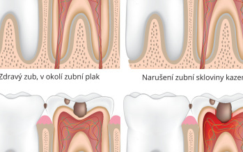 Zubní kaz