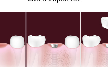 Dentální implantát