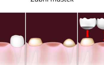 Dentální můstek