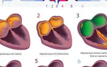 EKG záznam