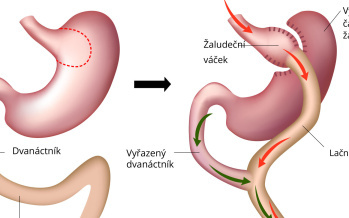 Gastrický bypass ROUX-en-Y spojka