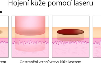 Hojení kůže pomocí laseru