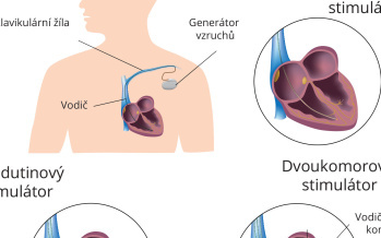 Implantace kardiostimulátoru