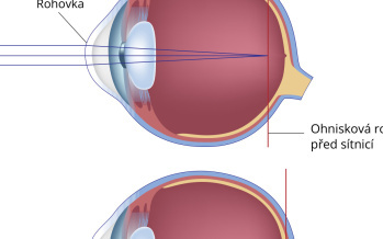Laserová operace očí – LASIK