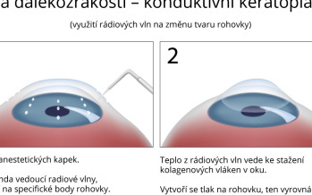 Léčba dalekozrakosti