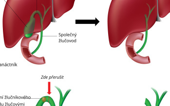 Odstranění žlučníku – cholecystektomie