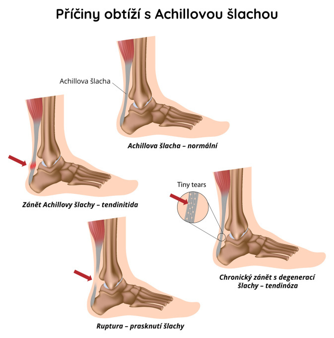 Obtíže s Achillovou šlachou