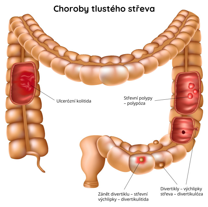 Choroby tlustého střeva (ulcerózní kolitida, střevní polypy, zánět divertiklu)