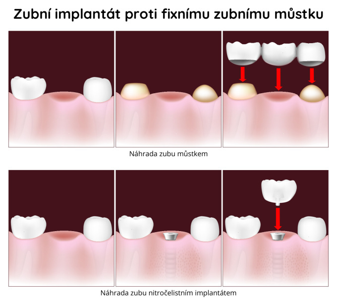 Zubní implantát proti fixnímu zubnímu můstku