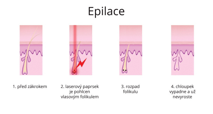 Laserová epilace