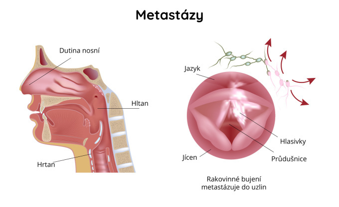 rakovinové bujení metastázuje do uzlin