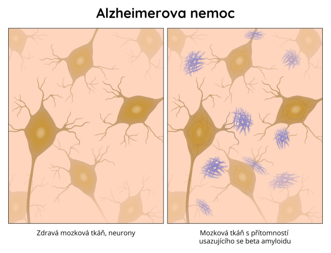 Alzheimerova nemoc