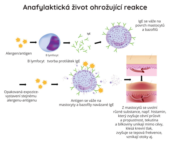 Anafylaktická život ohrožující reakce