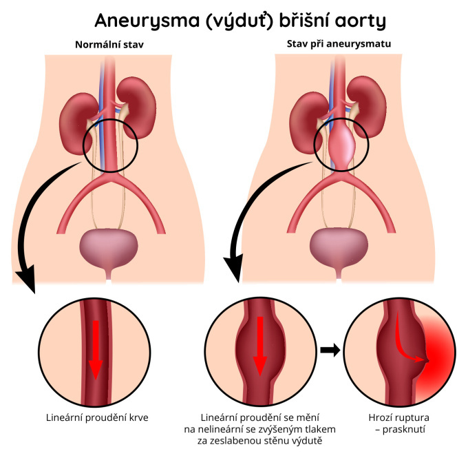 Aneurysma (výduť) břišní aorty